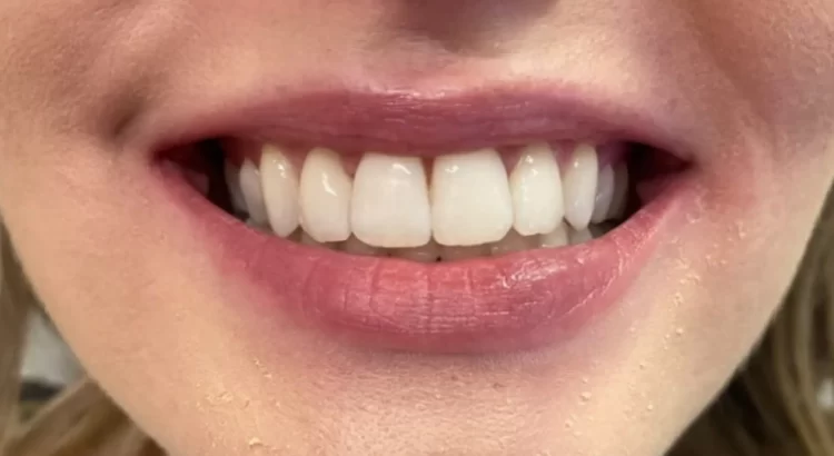 Accredited Teeth Whitening Course