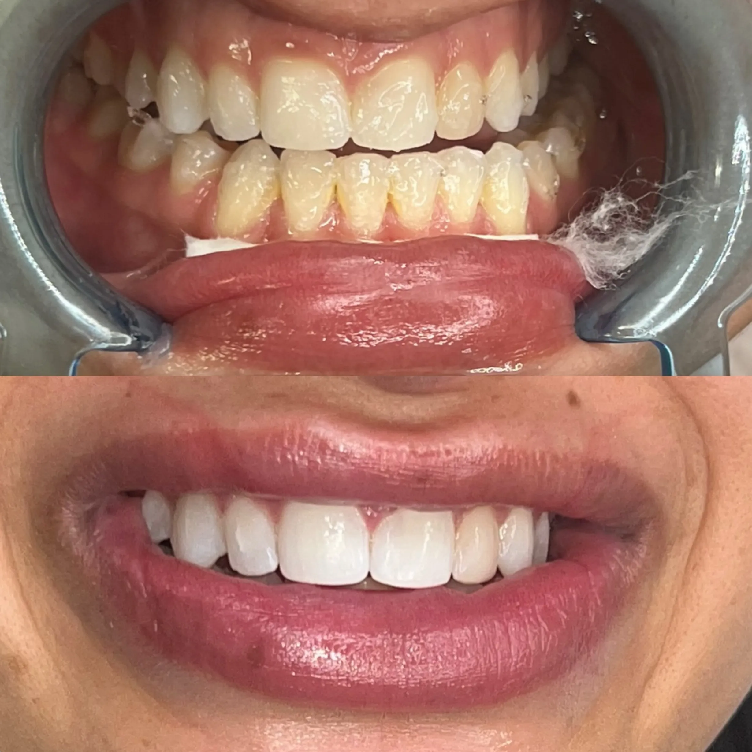 peroxide training teeth whitening