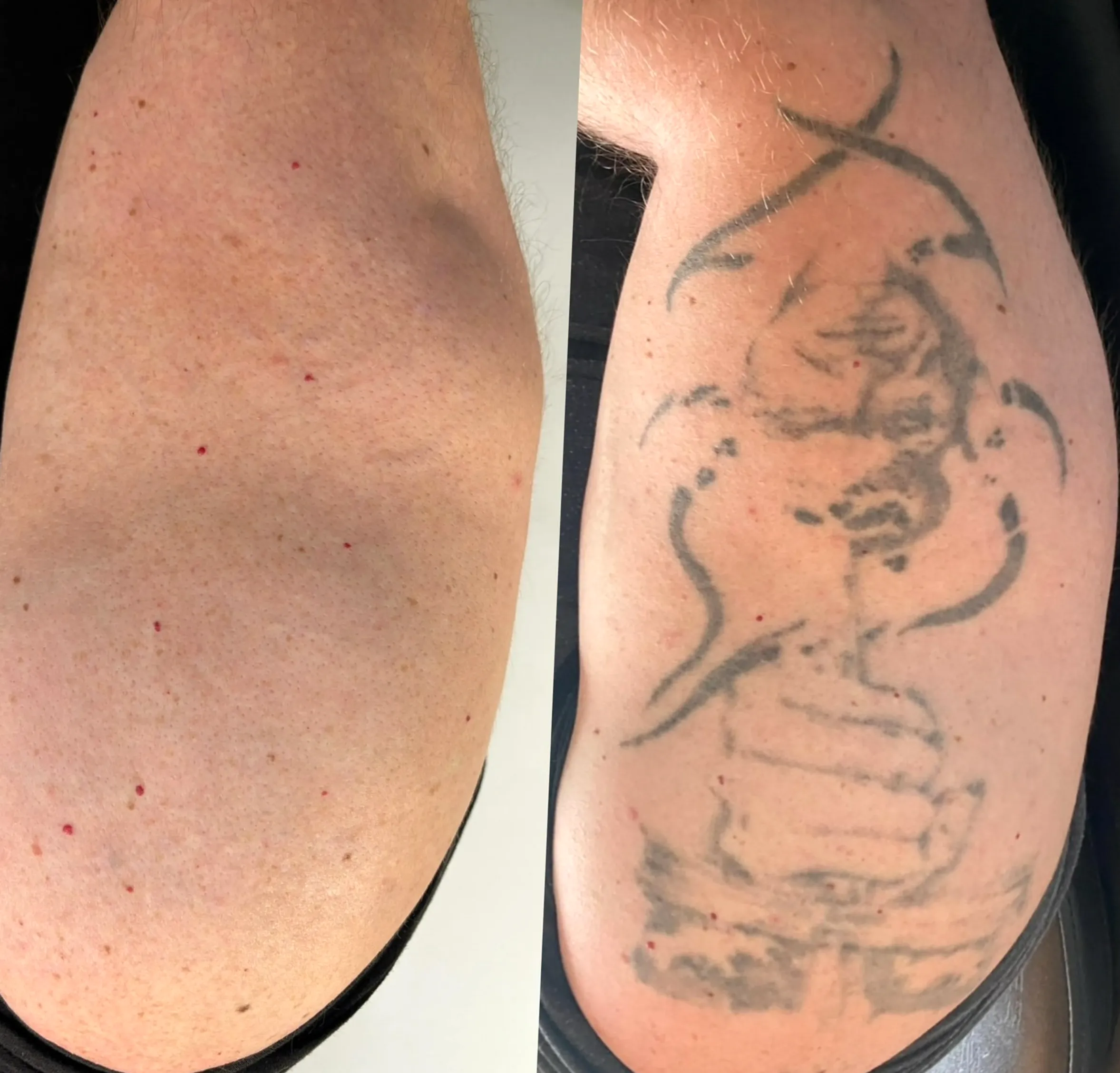 laser tattoo removal career