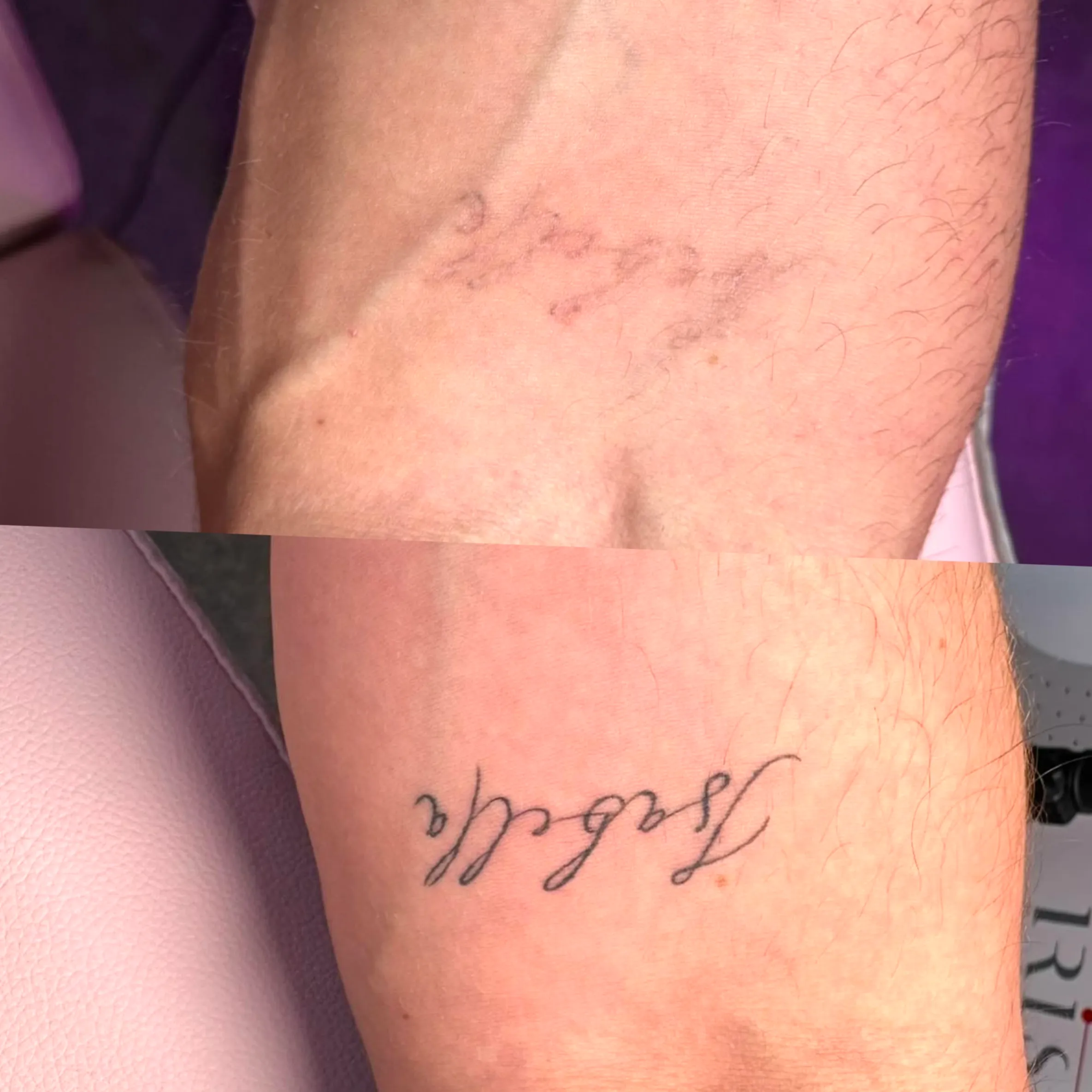 tattoo removal employability