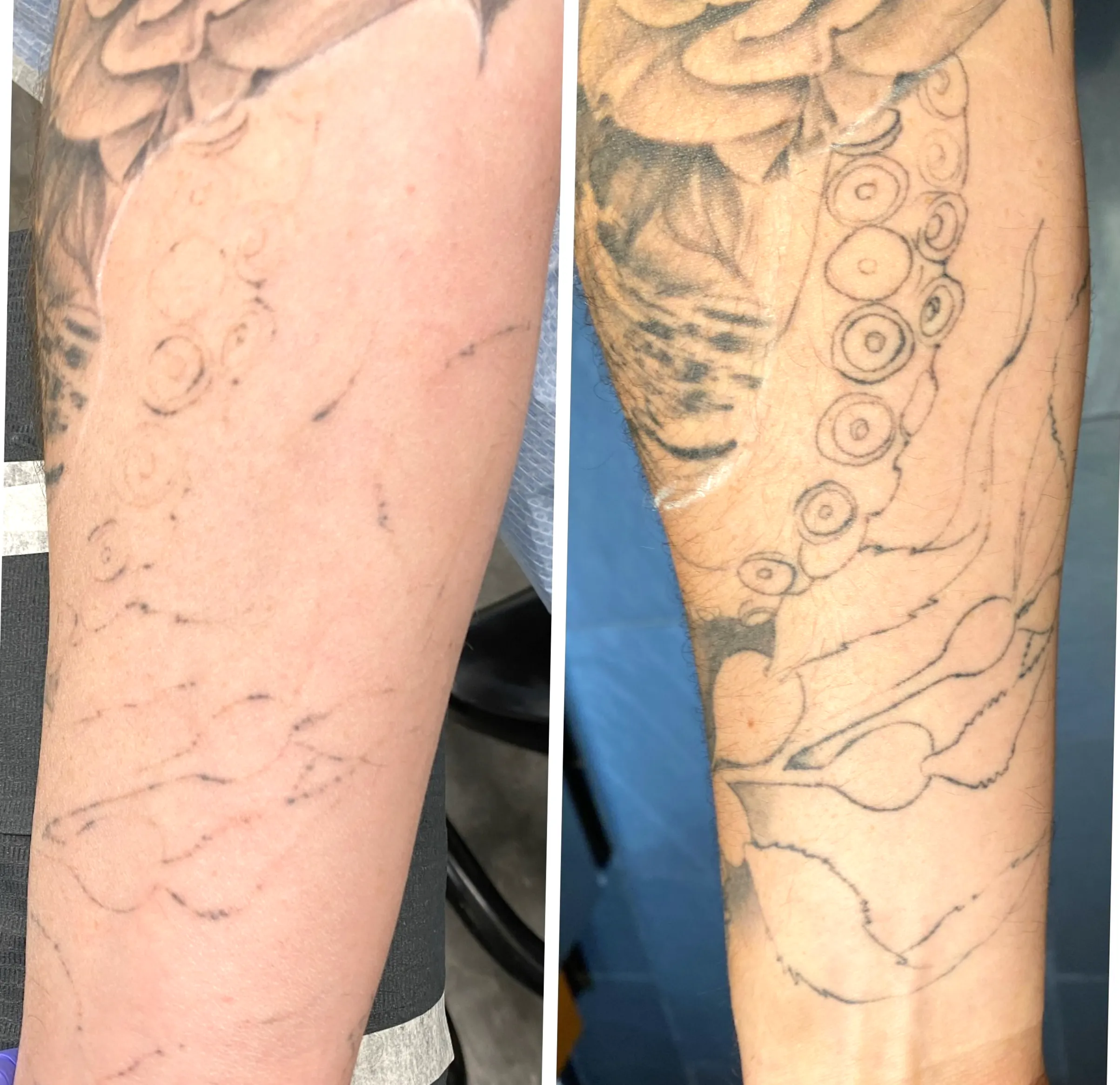 tattoo removal skills for salons