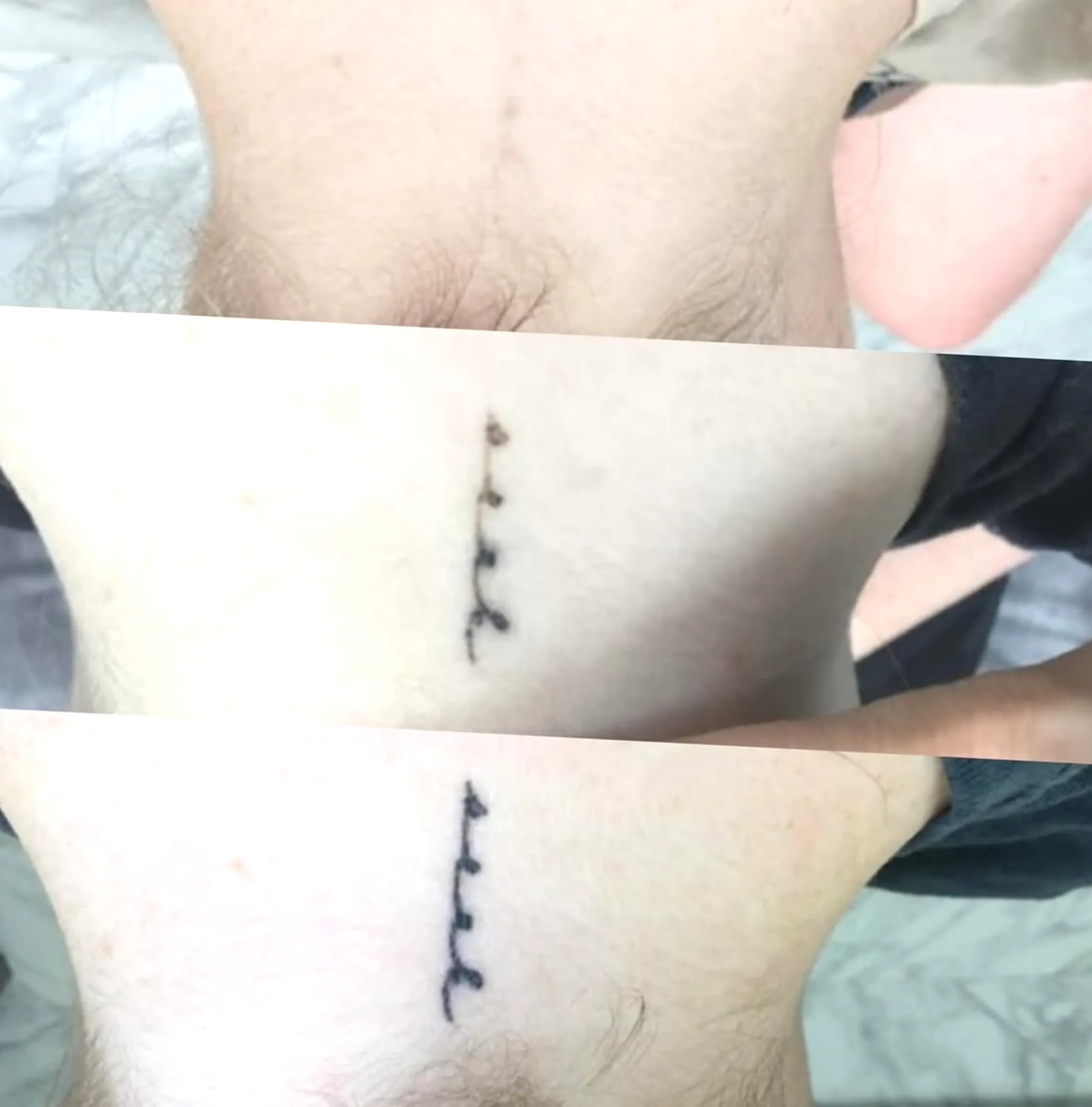 tattoo removal training Melbourne